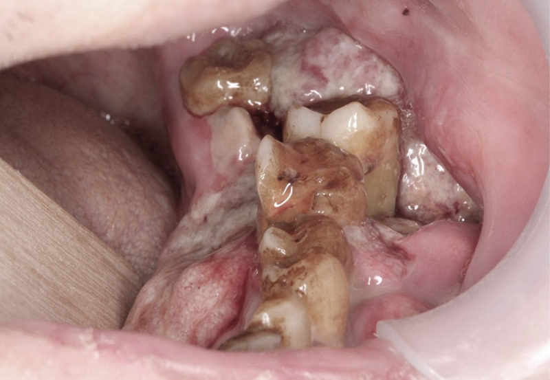 Left lower alveola cancer